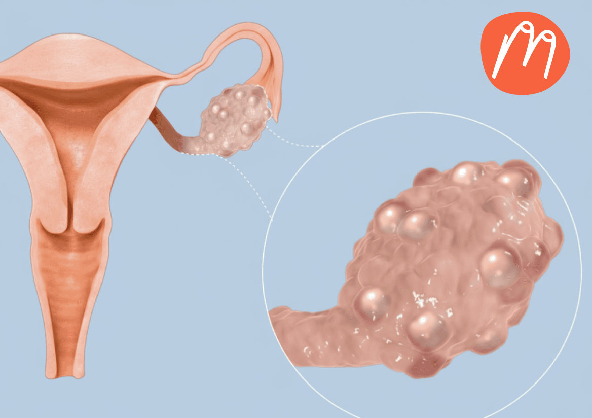 Mit PCOS leben – besonders im Sommer leiden Betroffene