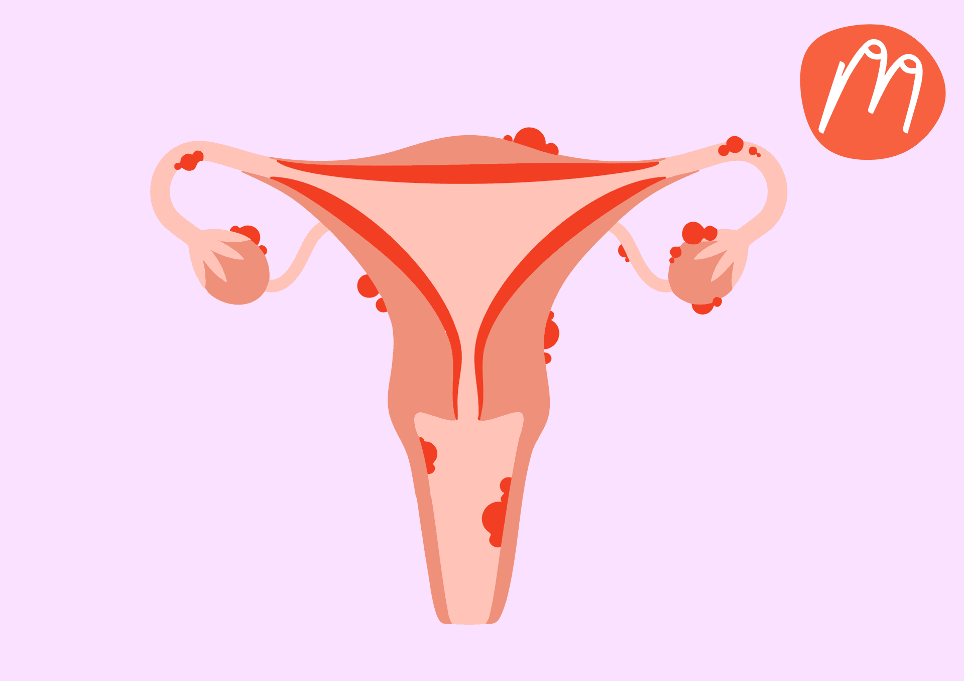 Die Diagnose-Odyssee: Warum Endometriose so oft übersehen wird