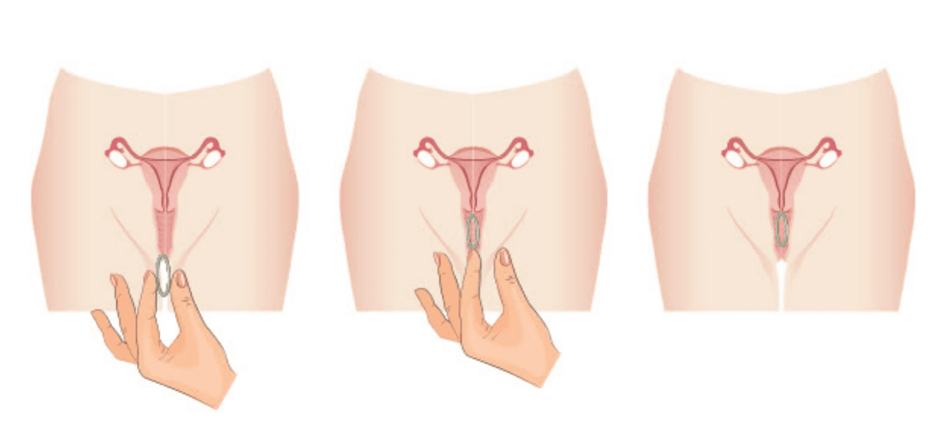 Vaginalring in den Wechseljahren: Lokale Hormonersatztherapie sinnvoll?