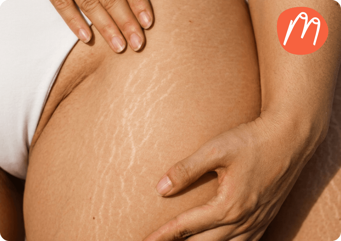 Bindegewebsschwäche: Warum es mehr als nur Cellulite ist und was wirklich hilft